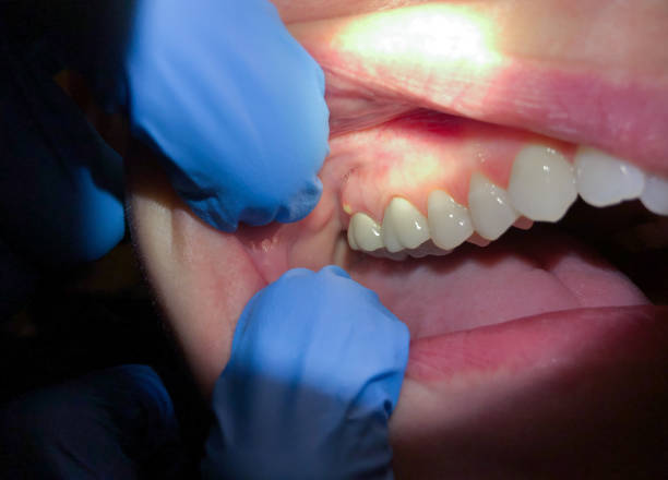 Teeth Whitening in WY